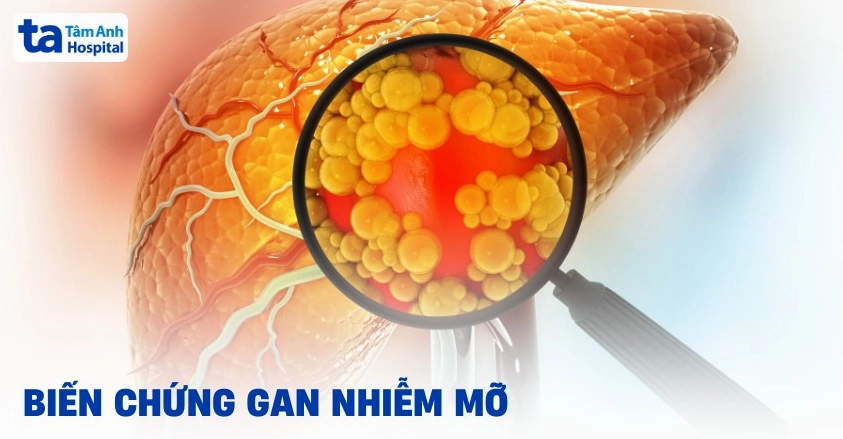 6 biến chứng gan nhiễm mỡ nguy hiểm, gây nhiều tác hại không ngờ