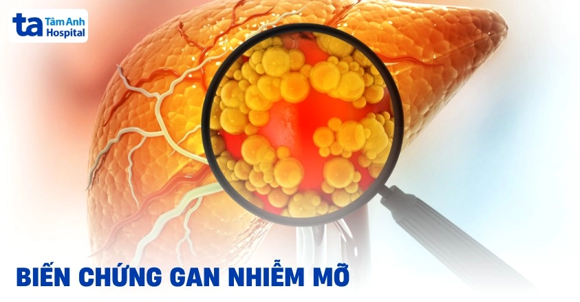 6 biến chứng nguy hiểm từ gan nhiễm mỡ