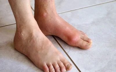 Bệnh Gout Nên Ăn Uống Gì? Bí Quyết Kiểm Soát Acid Uric Hiệu Quả Nhất