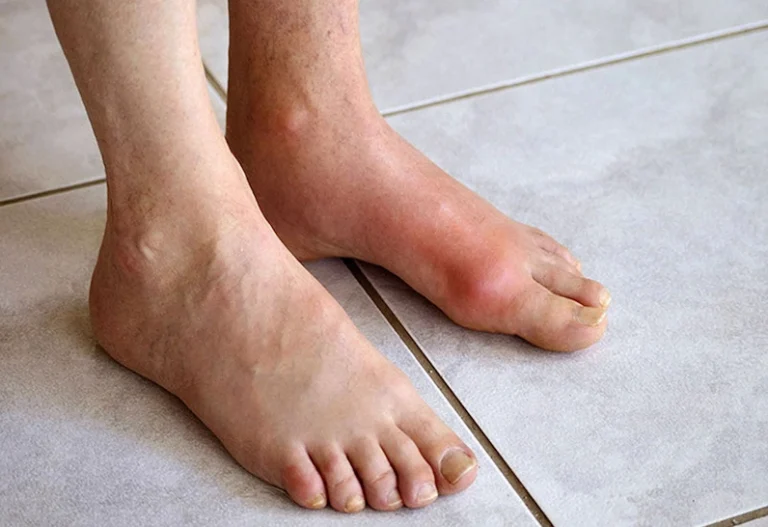 Bệnh Gout Nên Ăn Uống Gì? Bí Quyết Kiểm Soát Acid Uric Hiệu Quả Nhất