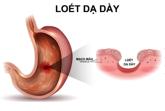 Bệnh lý viêm loét dạ dày có thể khiến tình trạng chướng bụng trở nên tồi tệ hơn