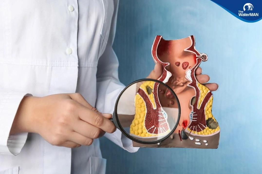 Bệnh trĩ gây khó chịu cho bệnh nhân rất nhiều