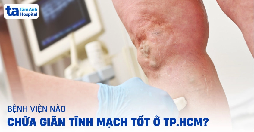 Bệnh viện chữa giãn tĩnh mạch tốt nhất TPHCM