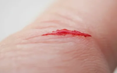 Bị vết thương hở nên ăn gì cho mau lành? Chế độ dinh dưỡng hồi phục