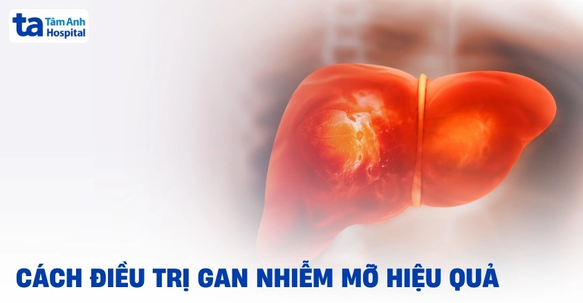 Cách điều trị gan nhiễm mỡ không dùng thuốc tại nhà