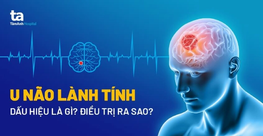Hình ảnh minh họa khối u não lành tính
