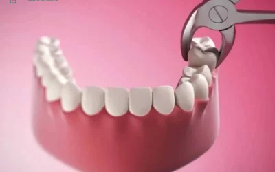 Mới nhổ răng nên ăn gì? Thực đơn hồi phục nhanh, tránh biến chứng