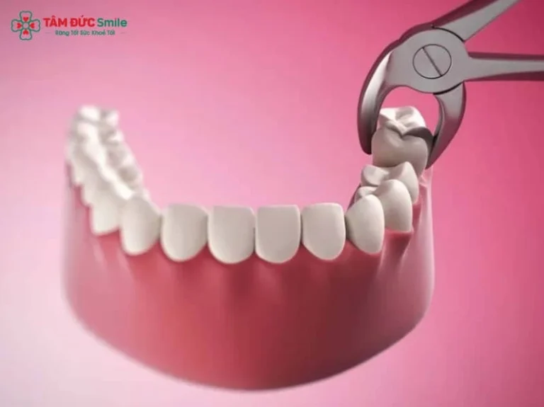 Mới nhổ răng nên ăn gì? Thực đơn hồi phục nhanh, tránh biến chứng