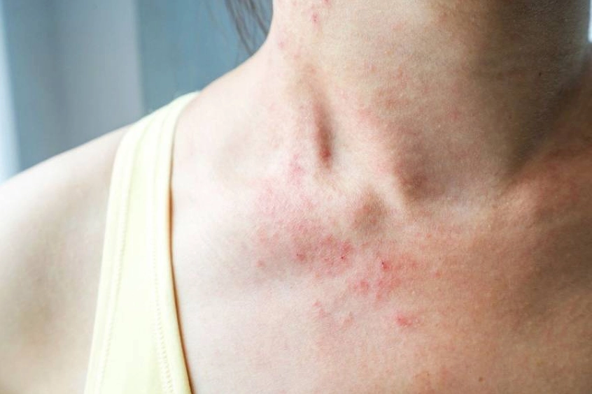 Người đang giảm cân cần lưu ý calo trong hạt mắc ca