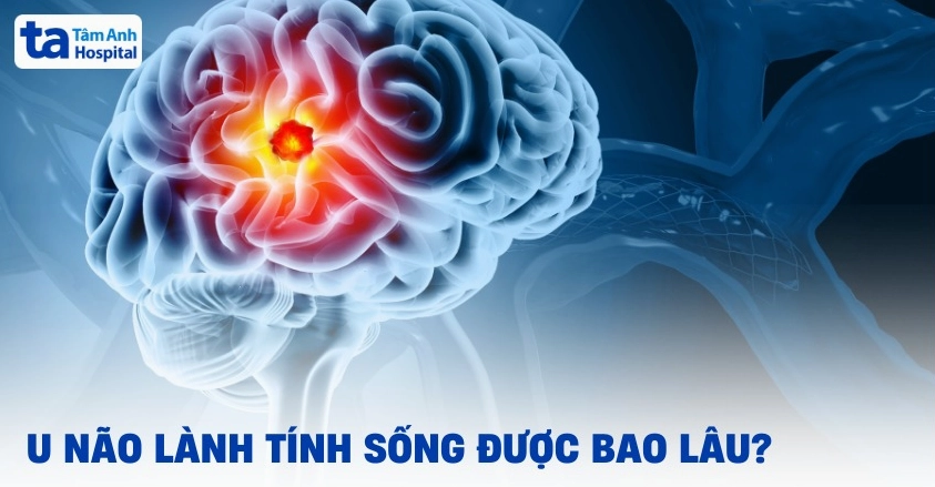 Sơ đồ vị trí các loại u não lành tính trong não