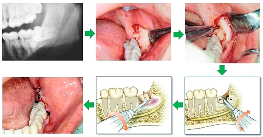 Tránh nhiễm trùng vết thương sau tiểu phẫu