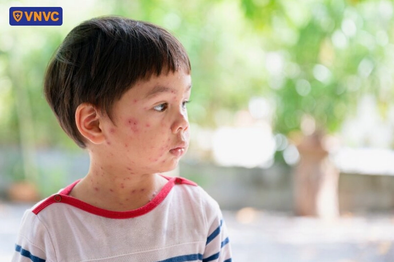 bé trai bị bệnh thủy đậu