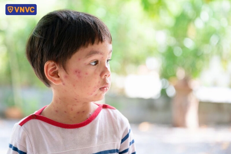 bé trai bị bệnh thủy đậu
