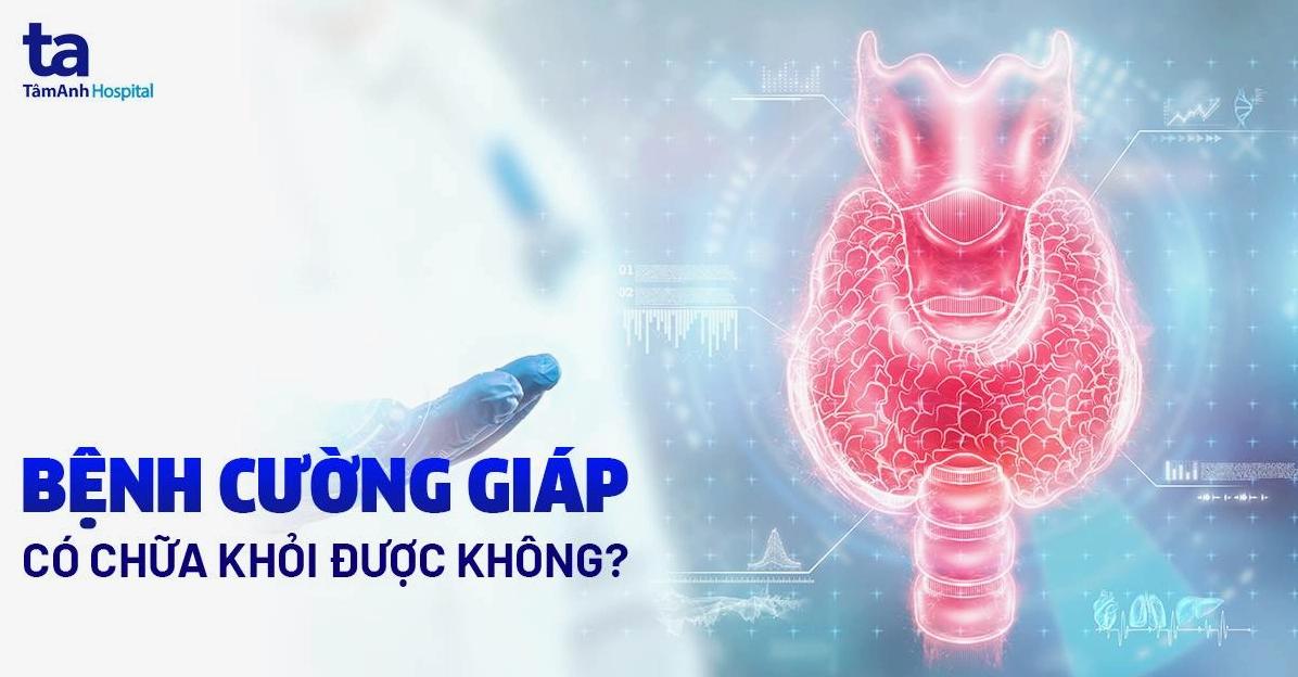 Bệnh cường giáp có thể chữa khỏi và kiểm soát tốt