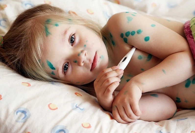 Bệnh thủy đậu có thể xảy ra ở cả người lớn và trẻ nhỏ