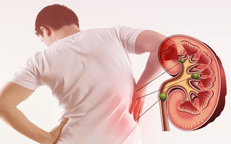 Bí Mật Chế Độ Ăn Cho Người Sỏi Thận: Những Thực Phẩm Cần Tránh Xa