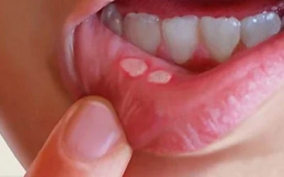 Bị nhiệt miệng nên ăn gì uống gì? Giải pháp phục hồi nhanh chóng