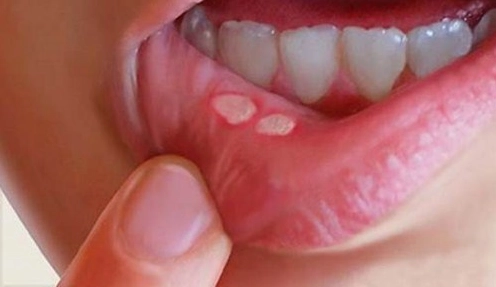 Bị nhiệt miệng nên ăn gì uống gì? Giải pháp phục hồi nhanh chóng