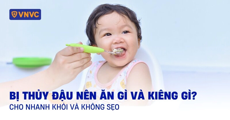 bị thủy đậu kiêng ăn gì