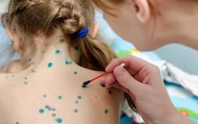 Bị Thủy Đậu Nên Ăn Gì? 15+ Thực Phẩm Vàng Giúp Nhanh Khỏi