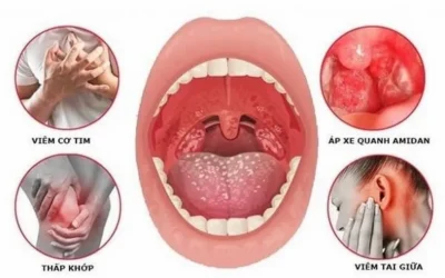 Bị Viêm Amidan Nên Ăn Gì, Kiêng Gì Để Nhanh Khỏi Bệnh?