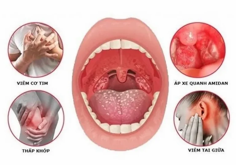 Bị Viêm Amidan Nên Ăn Gì, Kiêng Gì Để Nhanh Khỏi Bệnh?