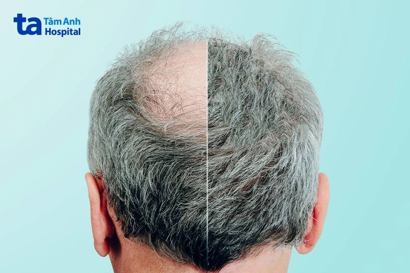 Các loại thực phẩm cần tránh khi bị rụng tóc