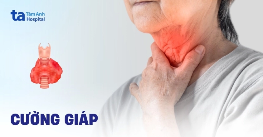 Các loại thực phẩm giàu i-ốt cần hạn chế khi bị cường giáp