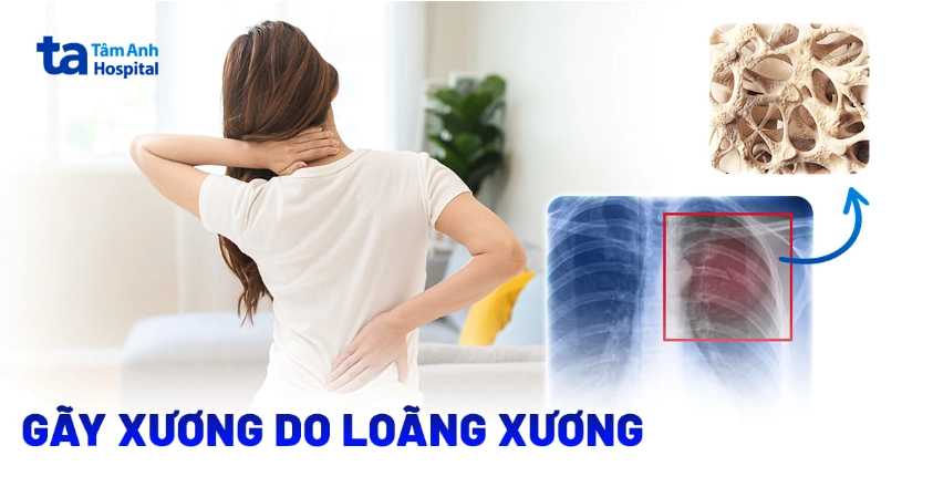 Gãy xương có thể do loãng xương, cần chú ý dinh dưỡng