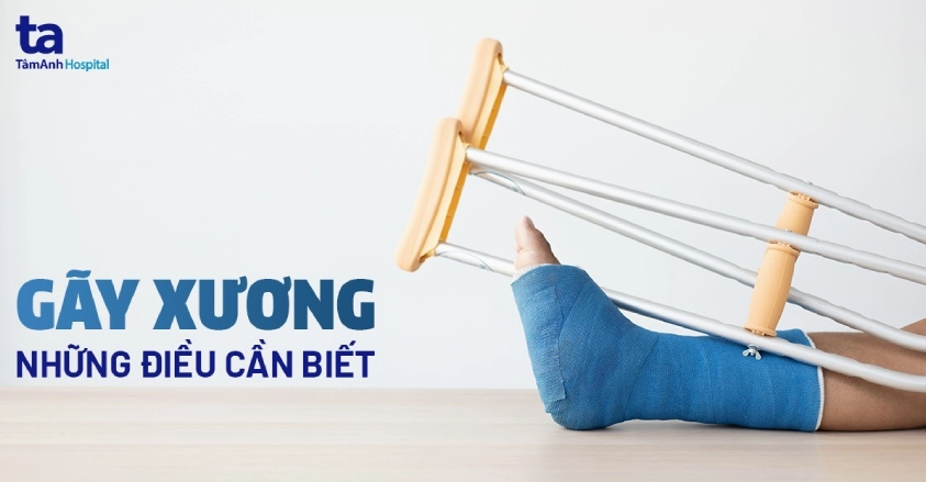 Gãy xương: Nguyên nhân, dấu hiệu, chẩn đoán và cách điều trị