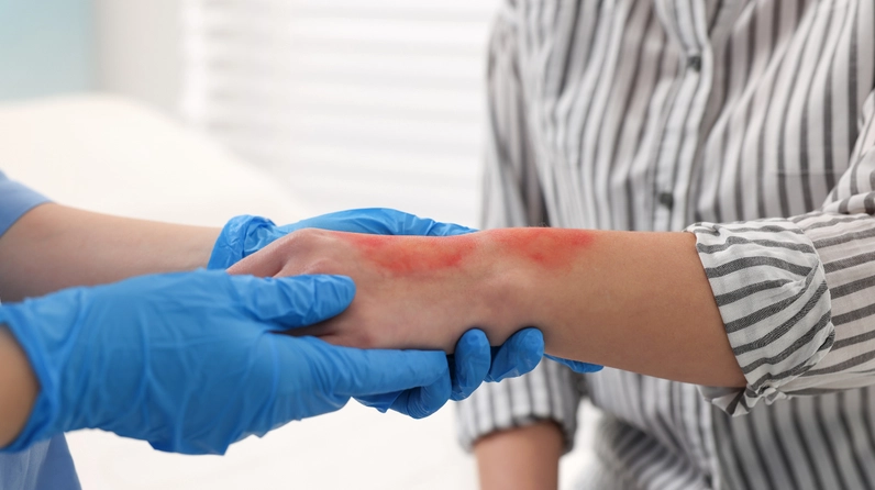 Giai đoạn sốc bỏng cần năng lượng cao để duy trì hoạt động sống