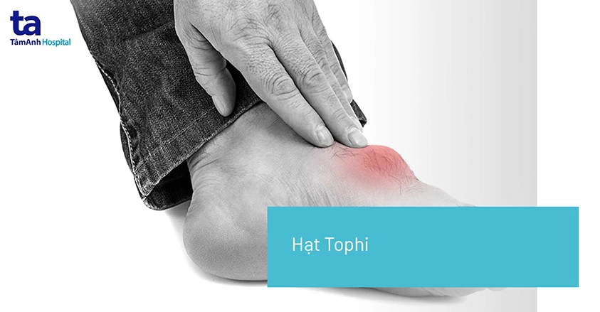 Hạt tophi (Nốt tophi): Nguyên nhân, triệu chứng và điều trị