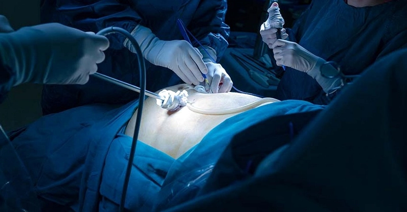 Mổ ruột thừa là phương pháp điều trị chính ở bệnh nhân viêm ruột thừa