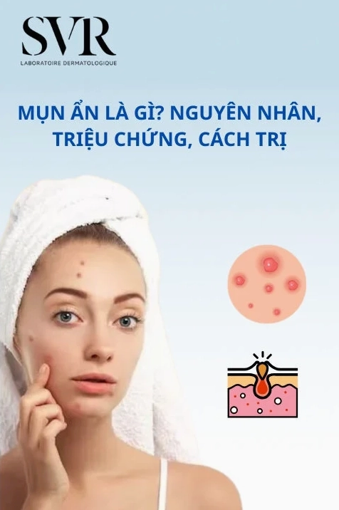 Mụn ẩn nên dùng gì? Bí quyết trị mụn ẩn hiệu quả tại nhà 2026
