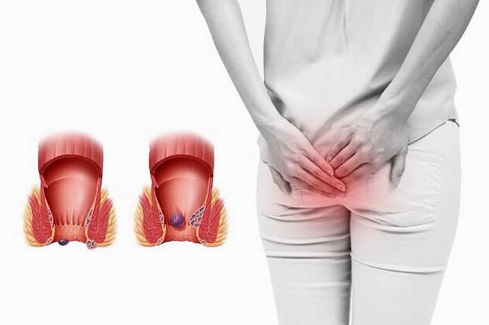 Người bệnh trĩ nên bổ sung nhiều chất xơ từ rau xanh và trái cây