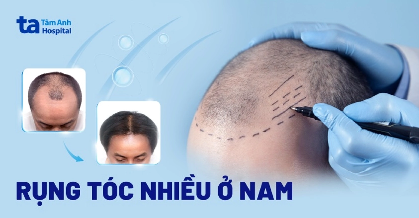 Nguyên nhân và cách giảm rụng tóc ở nam giới