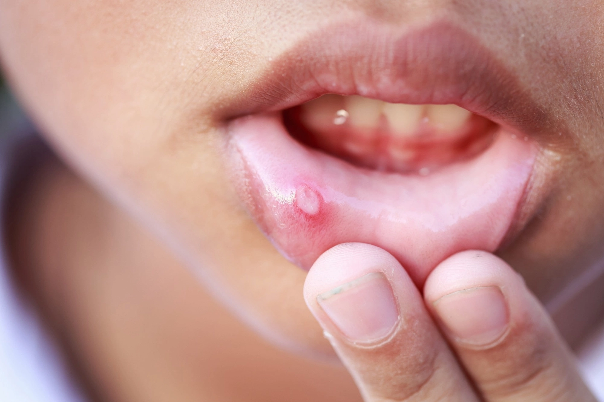 Nhiệt miệng gây đau rát khó chịu