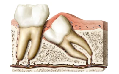 Nhổ Răng Khôn Xong Nên Ăn Gì? Bí Quyết Phục Hồi Nhanh