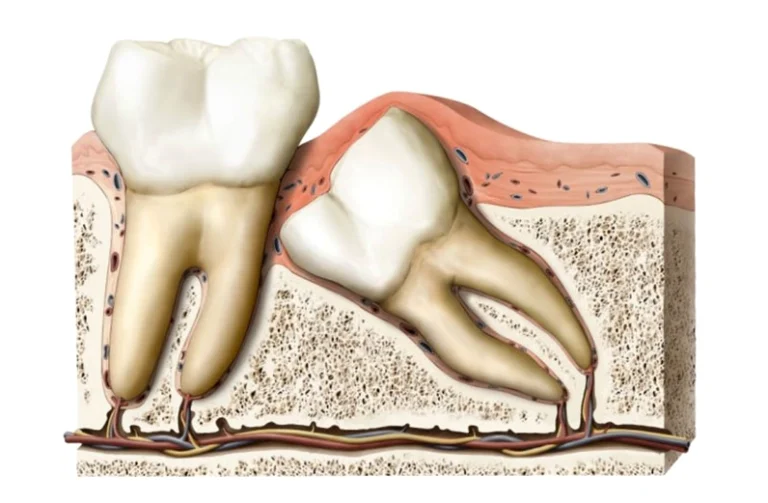 Nhổ Răng Khôn Xong Nên Ăn Gì? Bí Quyết Phục Hồi Nhanh