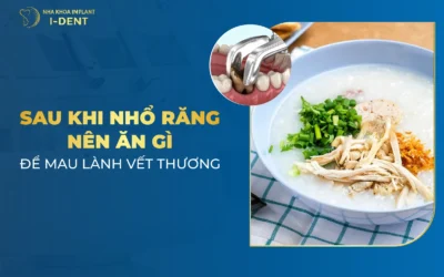 Nhổ Răng Xong Nên Ăn Gì 2026? Thực Đơn Phục Hồi Nhanh Chóng