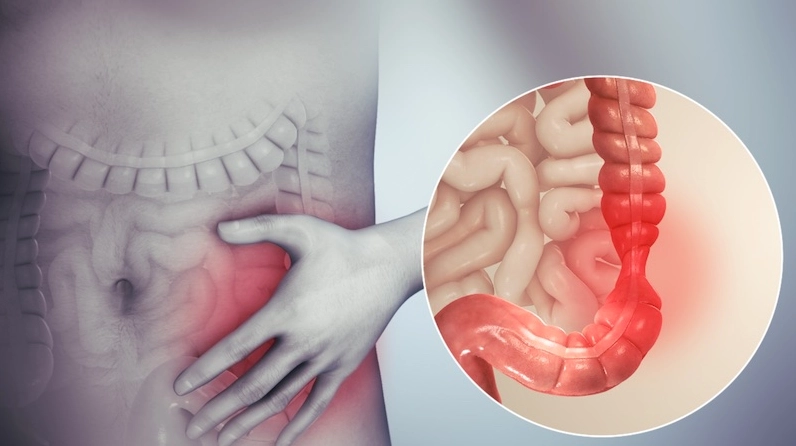 Những thông tin cơ bản về hội chứng ruột kích thích