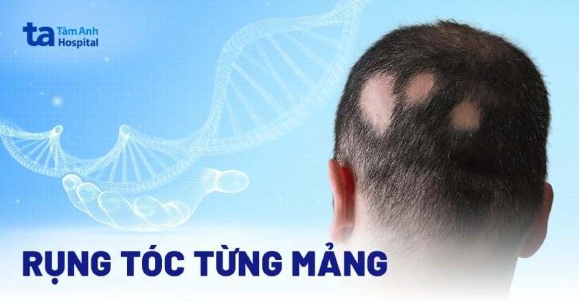 Rụng tóc từng mảng: Nguyên nhân và điều trị