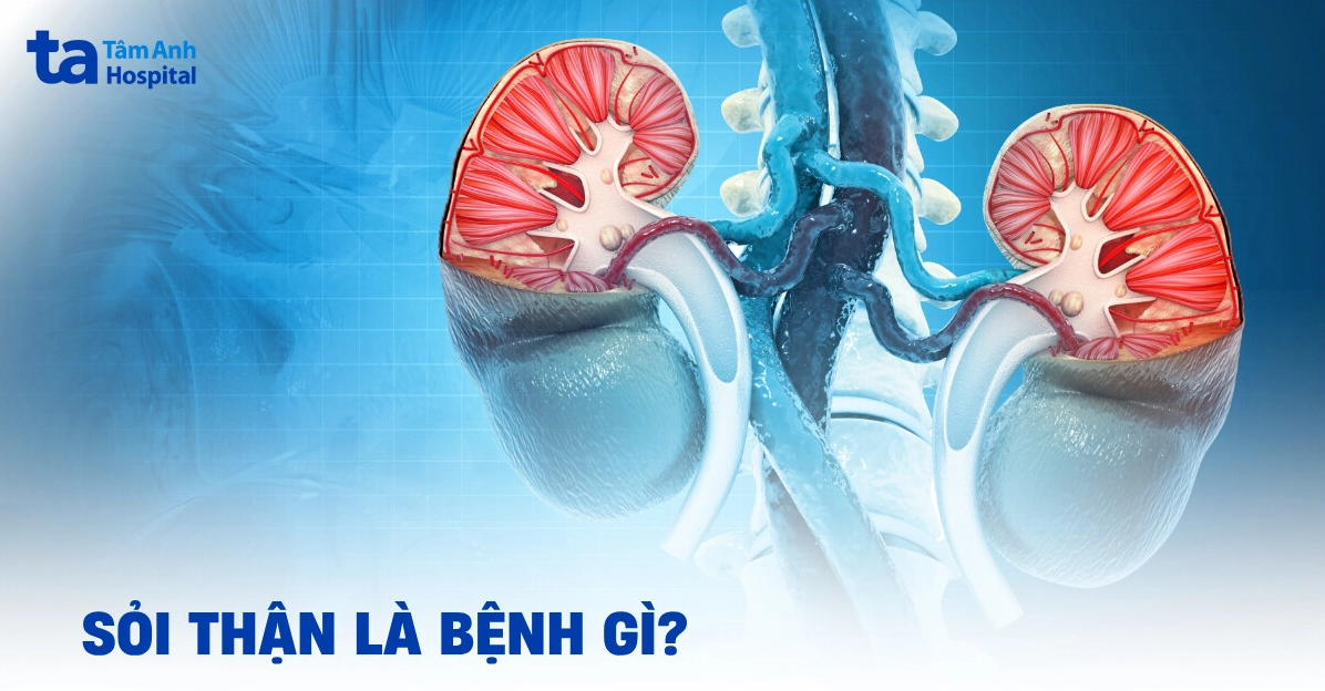 Sỏi thận: Nguyên nhân, dấu hiệu và cách điều trị