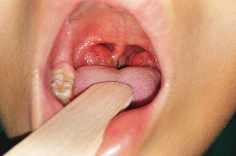 Tham khảo ý kiến bác sĩ về điều trị viêm amidan