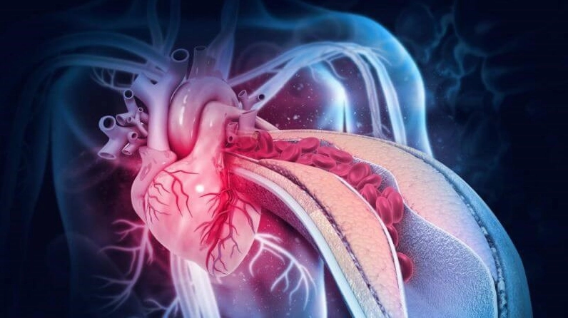 Thiếu máu cơ tim kéo dài có thể dẫn đến suy tim