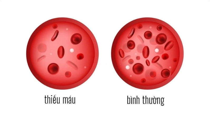Thiếu máu là tình trạng không đủ tế bào hồng cầu để đưa oxy từ máu đến các mô