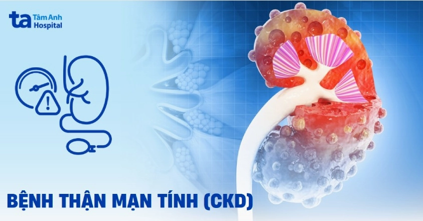 Tìm hiểu về bệnh thận mạn tính, nguyên nhân, triệu chứng và cách phòng ngừa.