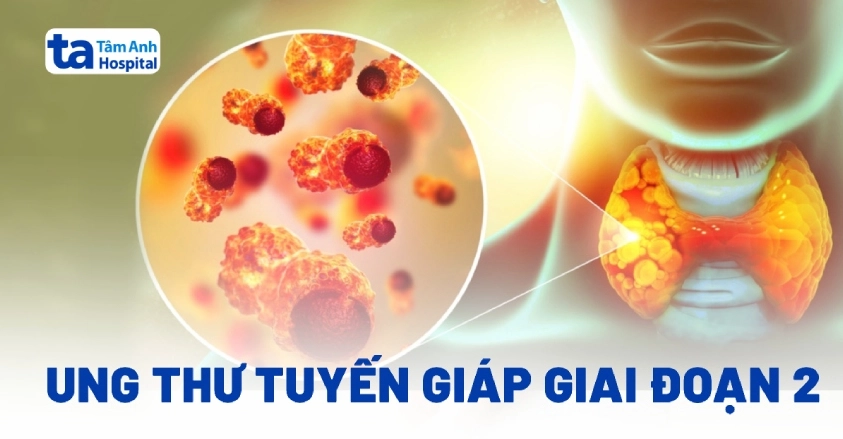 Ung thư tuyến giáp giai đoạn 2