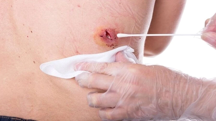 Vết thương hở cần được chăm sóc đúng cách và bổ sung dinh dưỡng hợp lý
