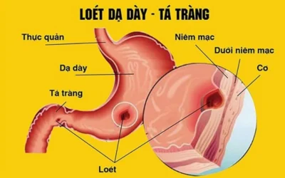 Viêm loét dạ dày nên ăn gì? Bí quyết giúp giảm đau hiệu quả
